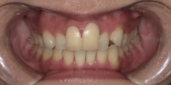 TEKを入れた画像|【症例】色が気になる前歯の被せ物をジルコニアセラミックで修復|京橋・銀座の歯医者 「京橋 銀座みらい歯科」
