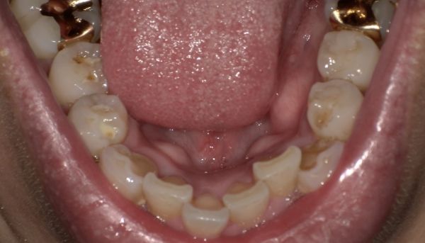 頬粘膜に線がはいっている画像①|【症例】色が気になる前歯の被せ物をジルコニアセラミックで修復|京橋・銀座の歯医者 「京橋 銀座みらい歯科」
