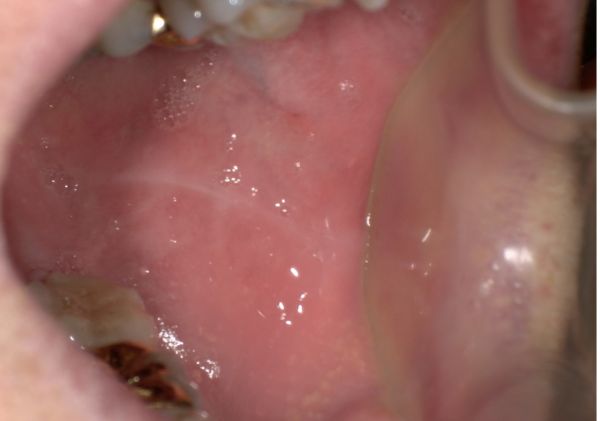 頬粘膜に線がはいっている画像②|【症例】色が気になる前歯の被せ物をジルコニアセラミックで修復|京橋・銀座の歯医者 「京橋 銀座みらい歯科」