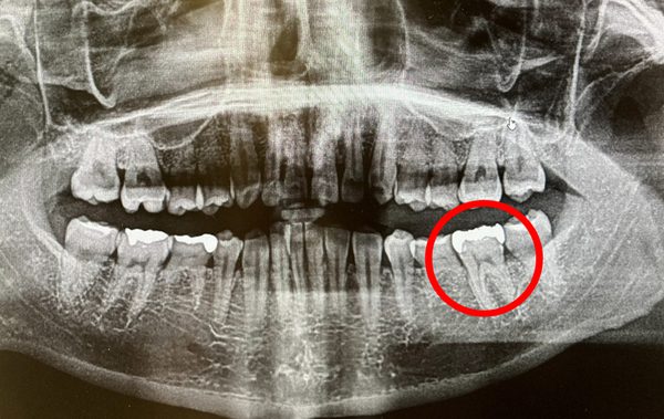 レントゲン写真│【症例】銀歯下の虫歯を除去しジルコニアインレー(ゼノスター)にて修復治療|京橋・銀座の歯医者 「京橋 銀座みらい歯科」